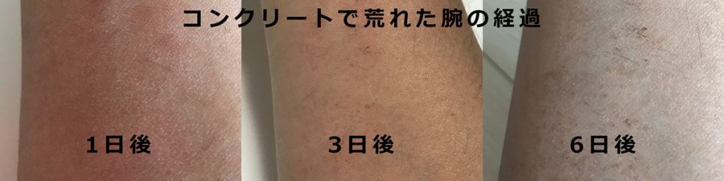 コンクリートで荒れた腕の経過(翌日・3日義6日後)