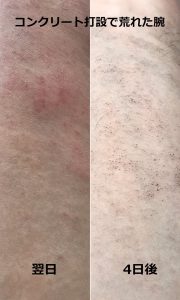 コンクリート打設で荒れた腕の翌日と4日後
