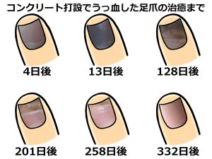 コンクリート打設でうっ血した足爪の治癒するまで